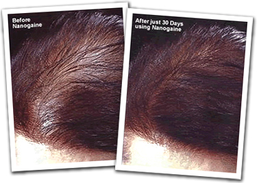 Nanogaine can Regrow Hair