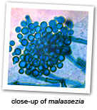 Infection common with Hair loss