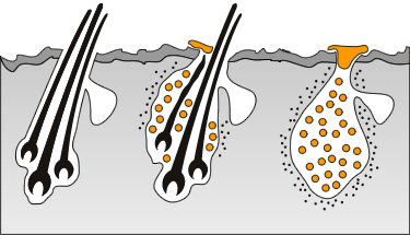 Sebum causes thinning hair